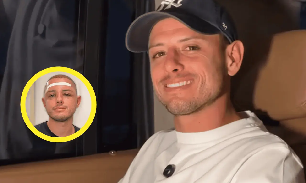  Chicharito Hernández mostró su rostro hinchado durante la recuperación de su injerto capilar. 