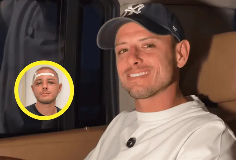 Chicharito Hern&aacute;ndez mostr&oacute; su rostro hinchado durante la recuperaci&oacute;n de su injerto capilar.